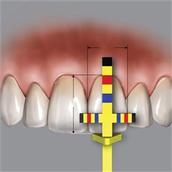 HuFriedyGroup Chu'S Aesthetic Gauges T-Bar Replacement Tips, 3-Pack