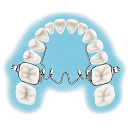 NAOL Nitanium Palatal Expander, 34mm