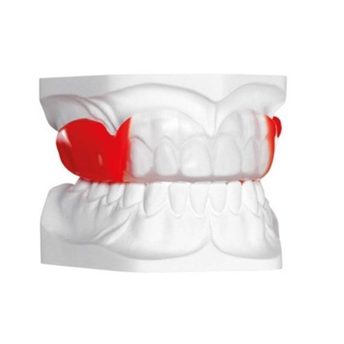 Bioplast Xtreme 125 x 5.0 mm Kit Red Round Pack of 1